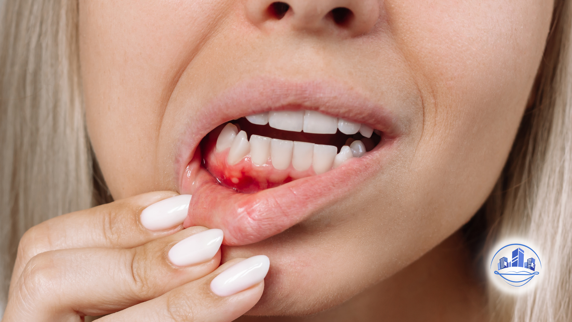 Woman with inflamed gums, bleeding from lower lip.