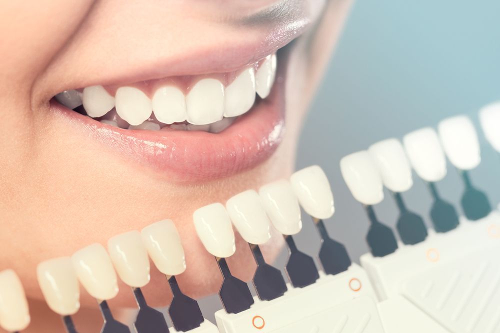A close up of a woman 's teeth with a tooth color chart.