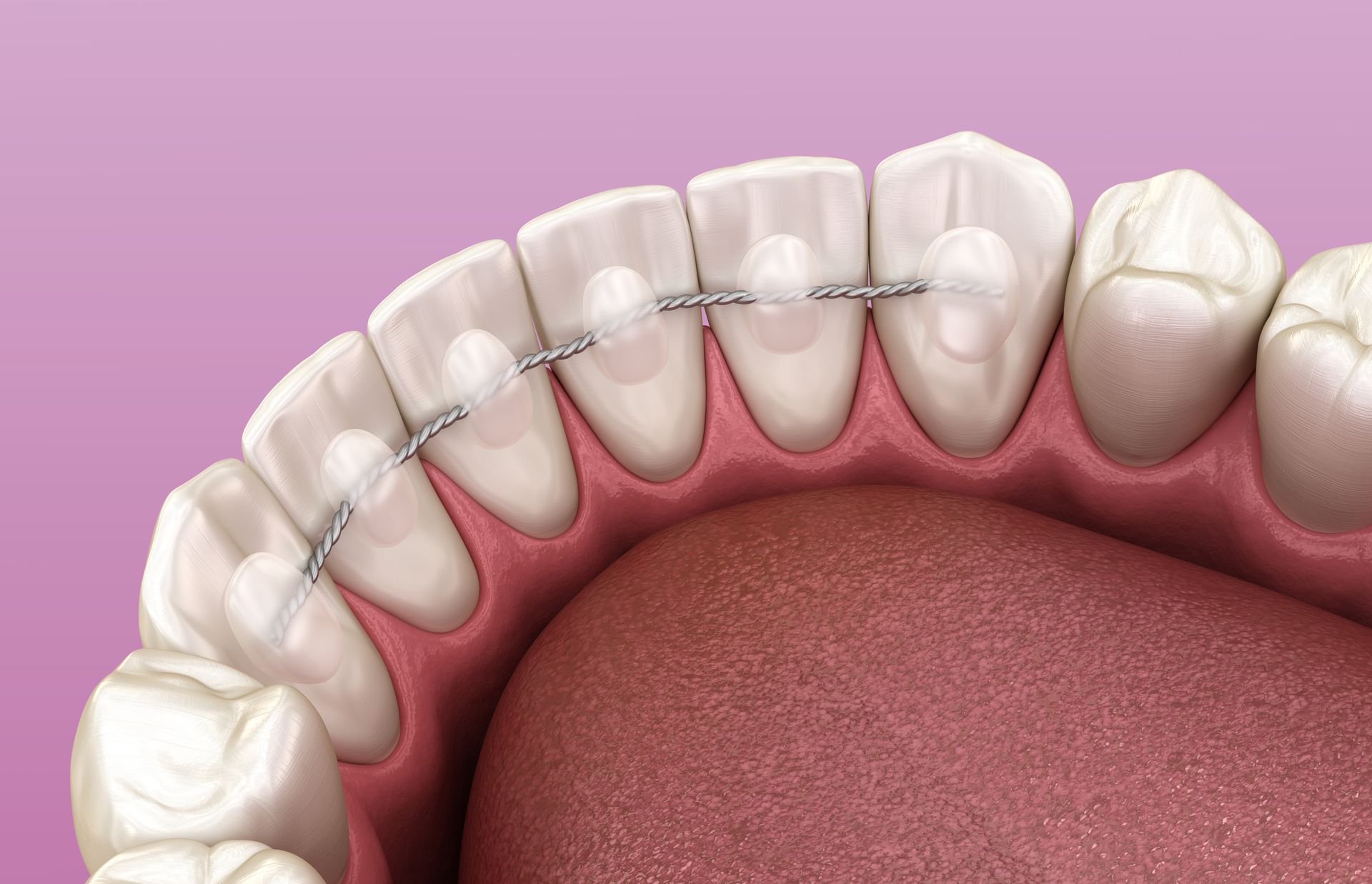 A close up of a person 's teeth with braces on them.