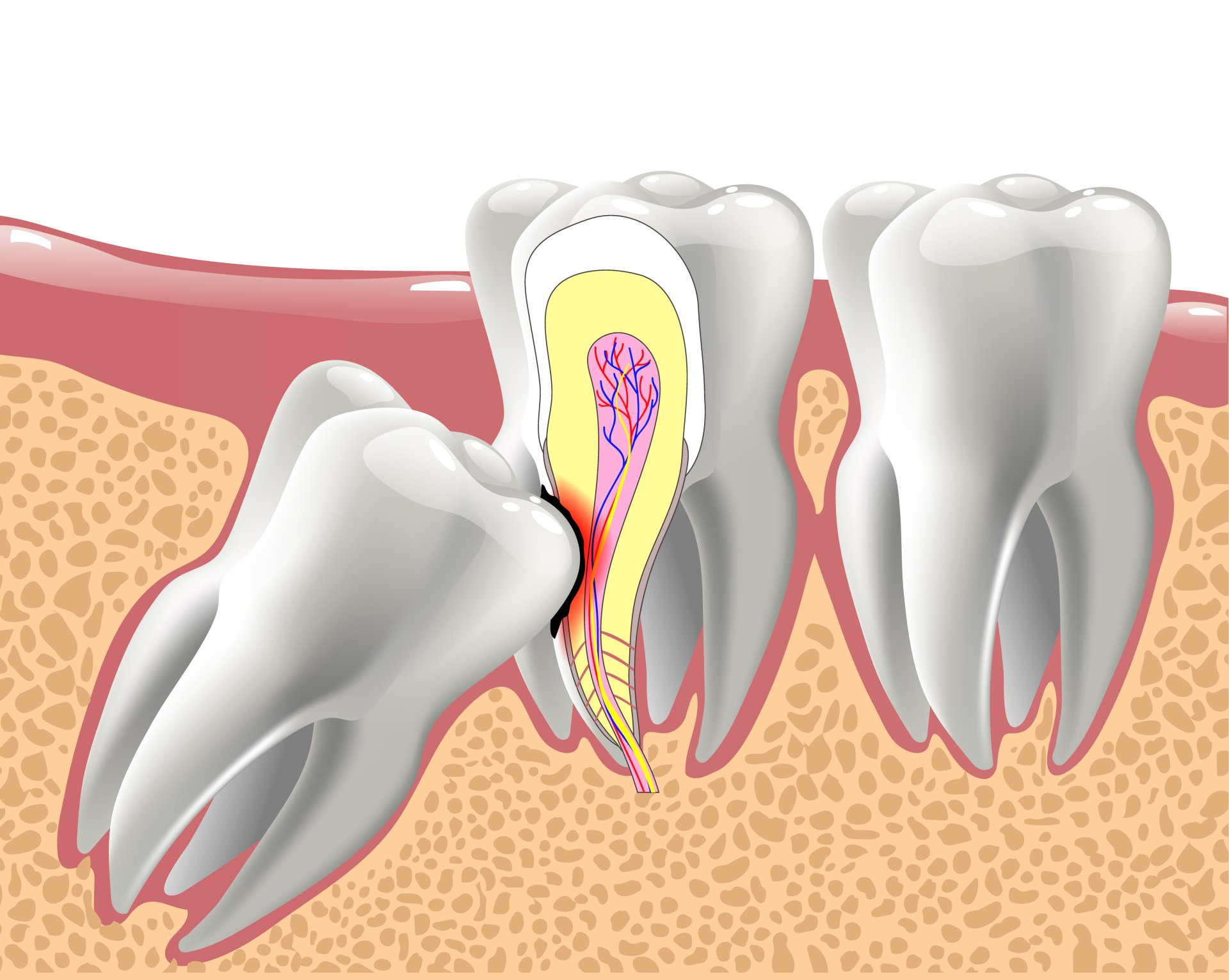 A diagram of a tooth with a hole in it.
