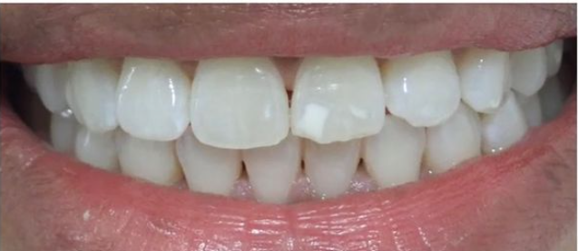 After Zoom Whitening