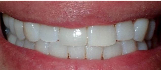 After Zoom Whitening