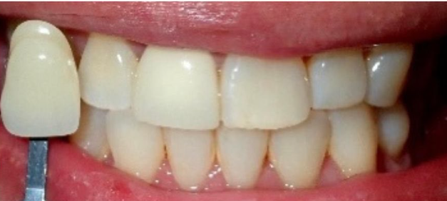 Before Zoom Whitening