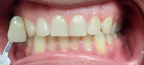 Before Zoom Whitening