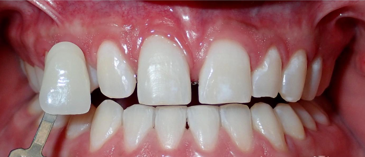 After Zoom Whitening