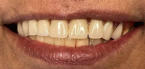 After Partial Dentures