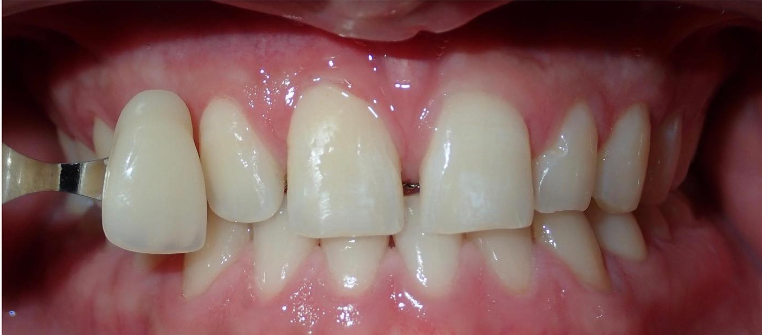 Before Zoom Whitening