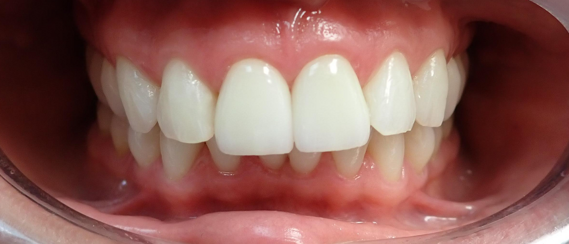 After Crowns Dental