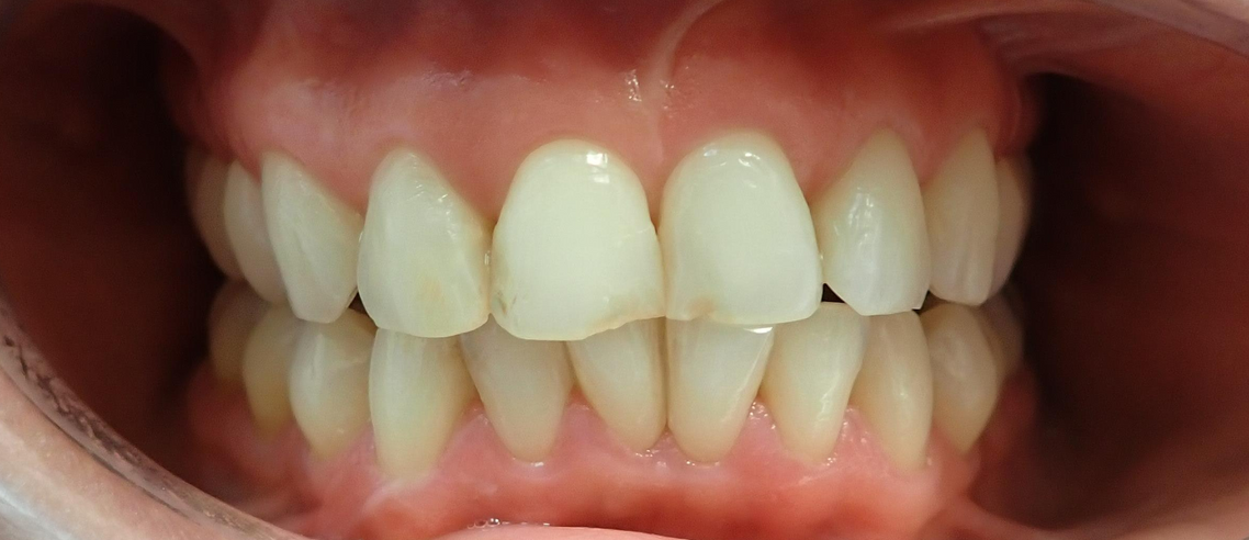 Before Crowns Dental