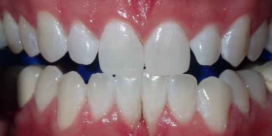 After Zoom Whitening