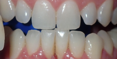 Before Zoom Whitening