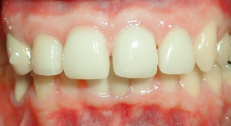 Before Crowns Dental