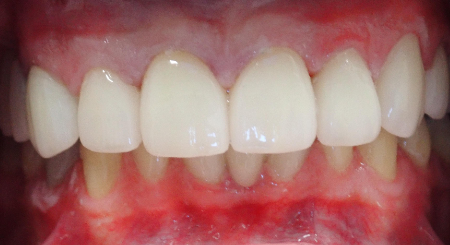 After Crowns Dental