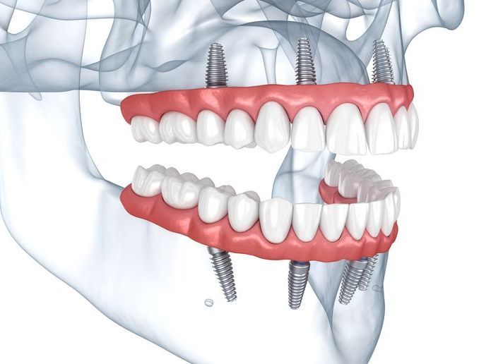 complete dental works dental implants