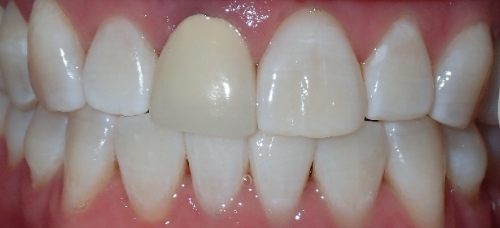 Before Zoom Whitening