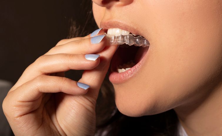 invisalign clear aligners