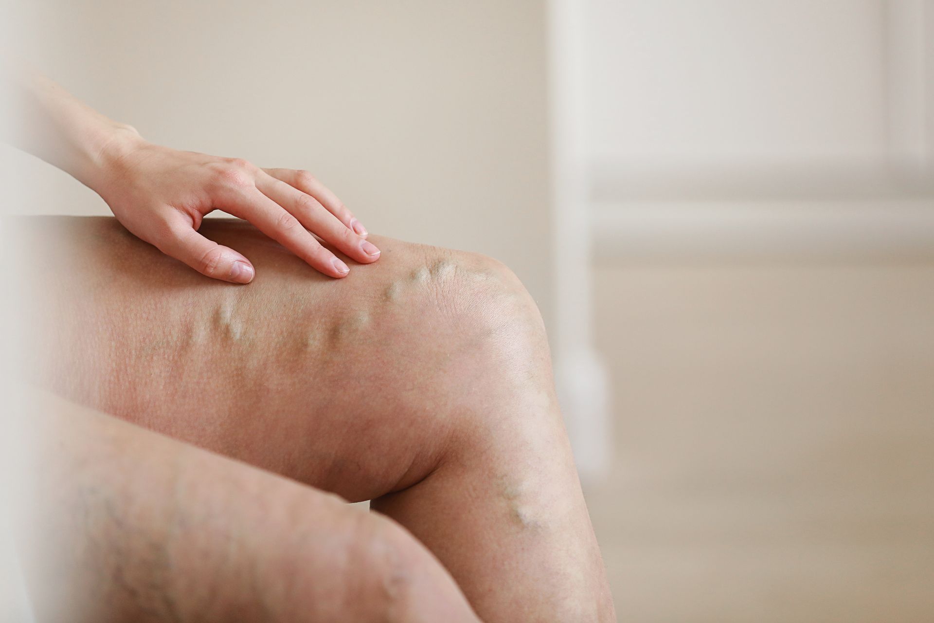 Escleroterapia a Laser Combinada com Escleroterapia com Glicose