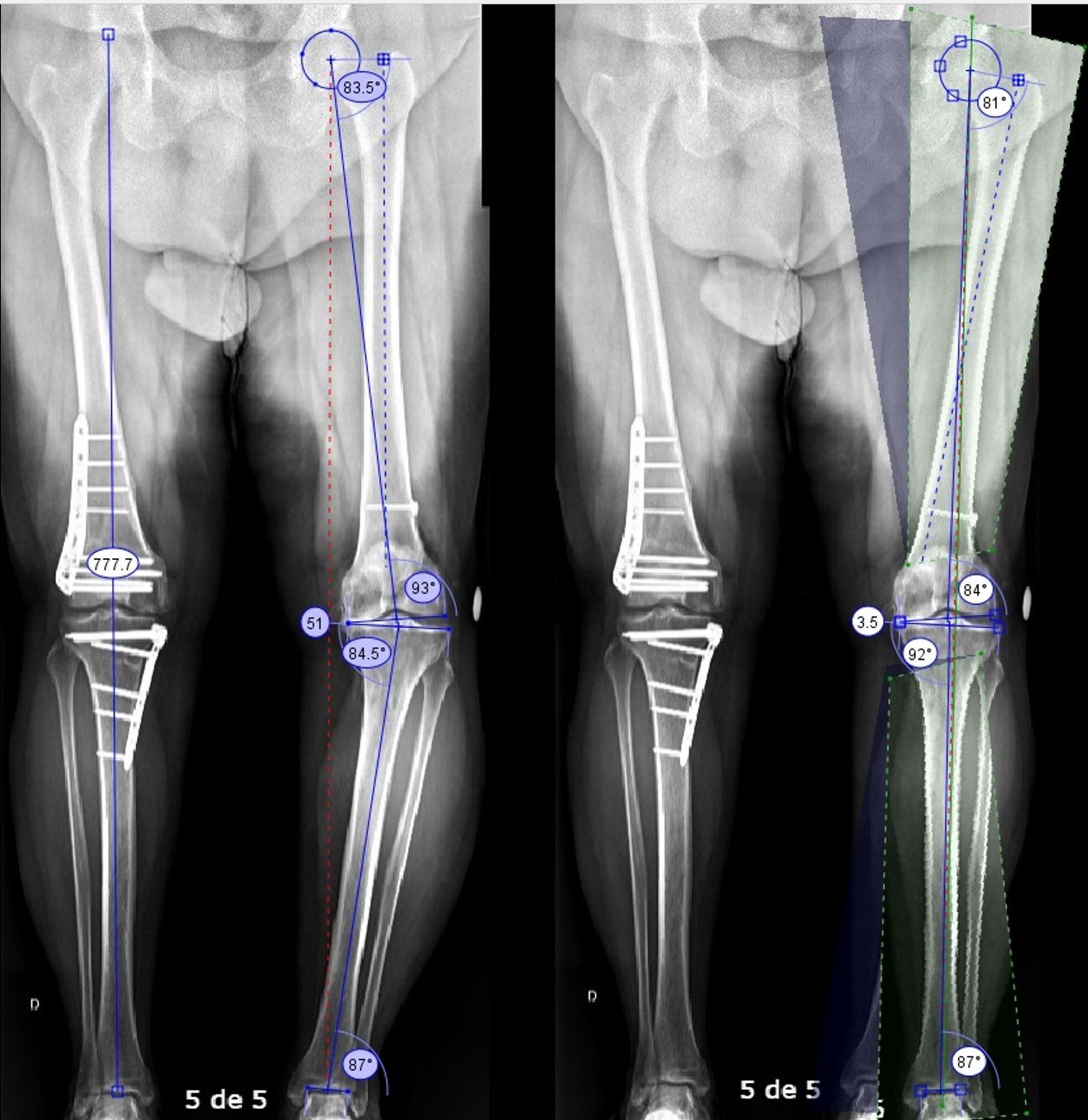 radiografias mostrando planejamento de osteotomia do joelho