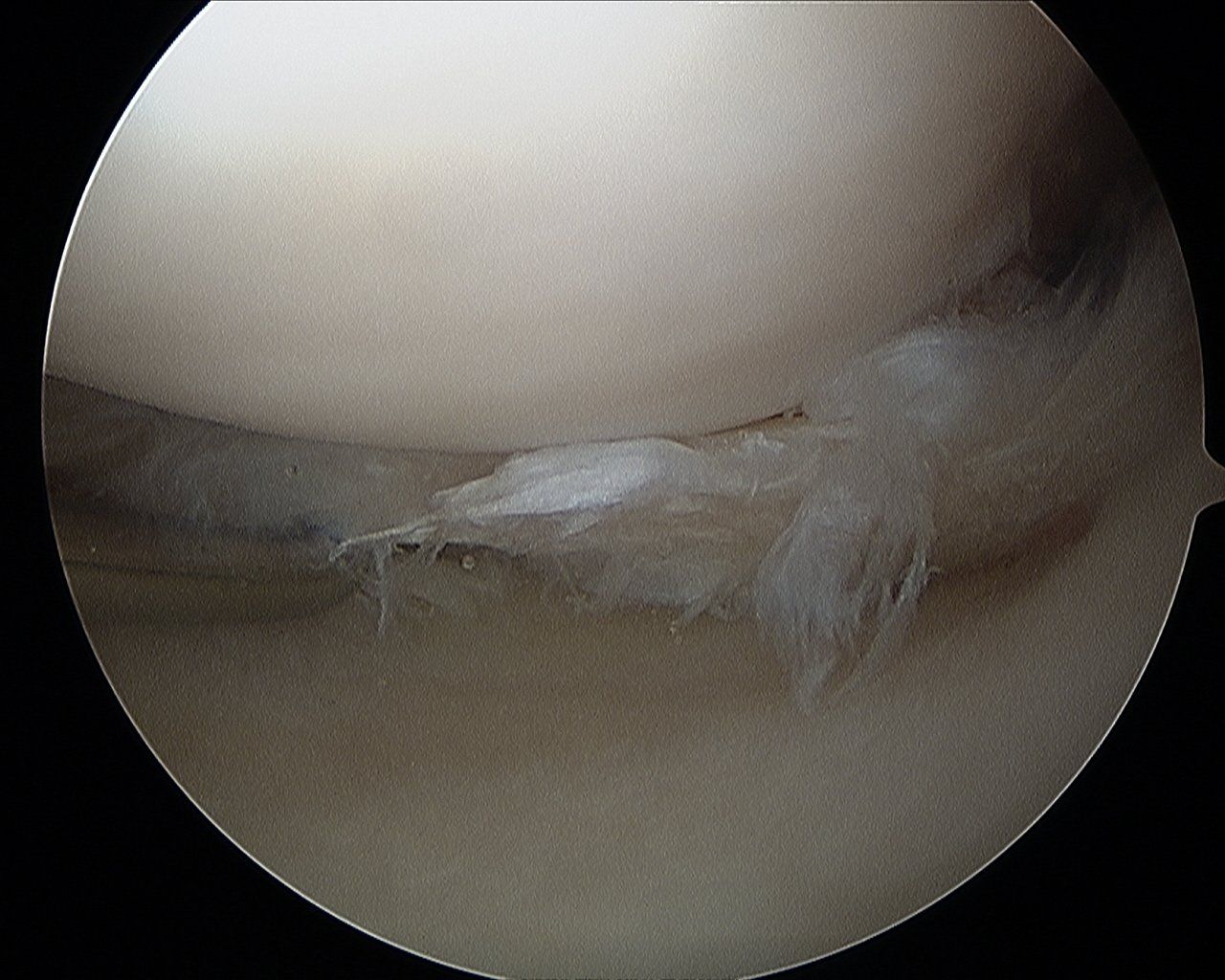Artroscopia mostrando lesão degenerativa do menisco