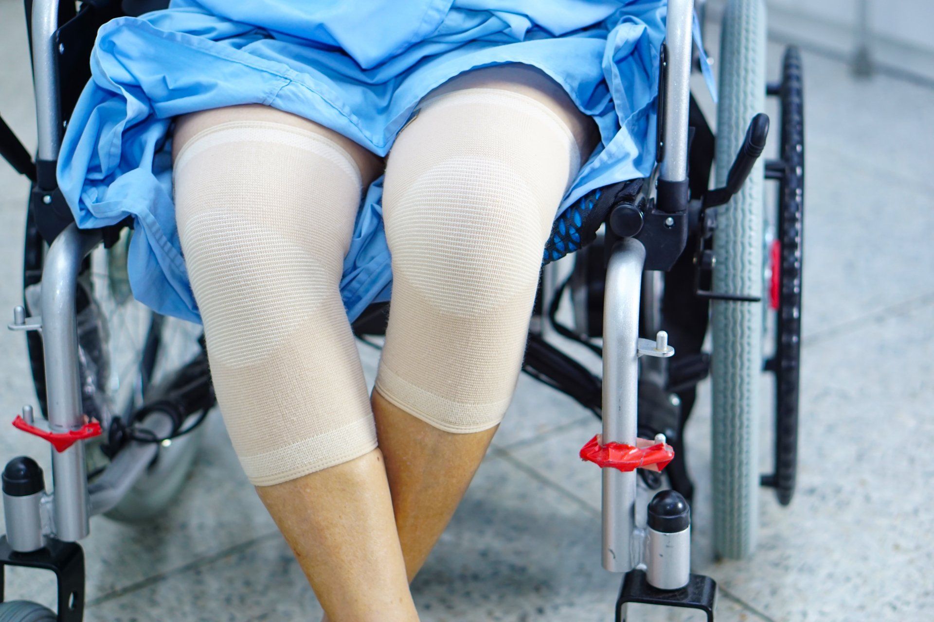 Paciente operada dos 2 joelhos simultaneamente - colocação de prótese