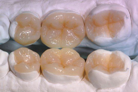 Intarsi Dentali: Studio Dentistico Vecchiotti Marco Cesena