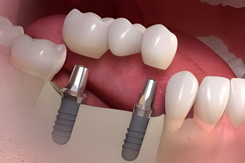 Cura delle Carie: Studio Dentistico Vecchiotti Cesena