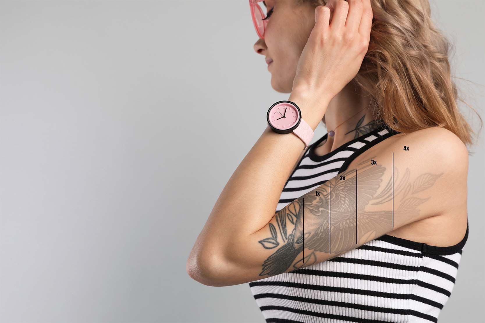 Woman with a partially faded tattoo on her upper arm, showing four stages of laser tattoo removal from dark to nearly invisible ink, used to demonstrate multi-session results.