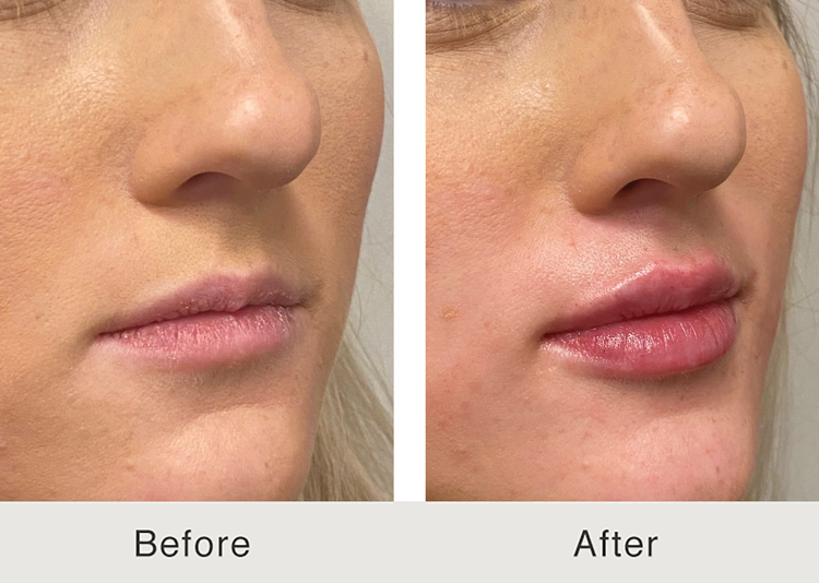 Before-and-after comparison of dermal filler treatment results.