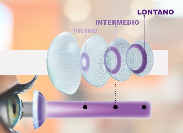 Lenti a contatto progressive - multifocali come funzionano le Lenti a contatto progressive - multifocali