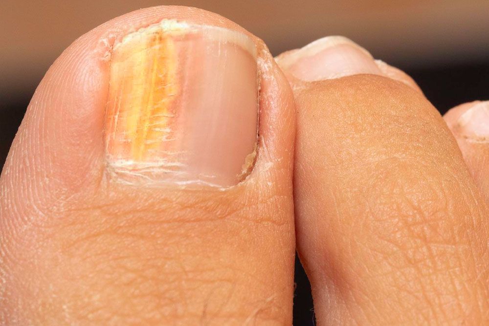 A Person is Getting a Laser Treatment on Their Toenail — Maitland Central Podiatry in Maitland NSW