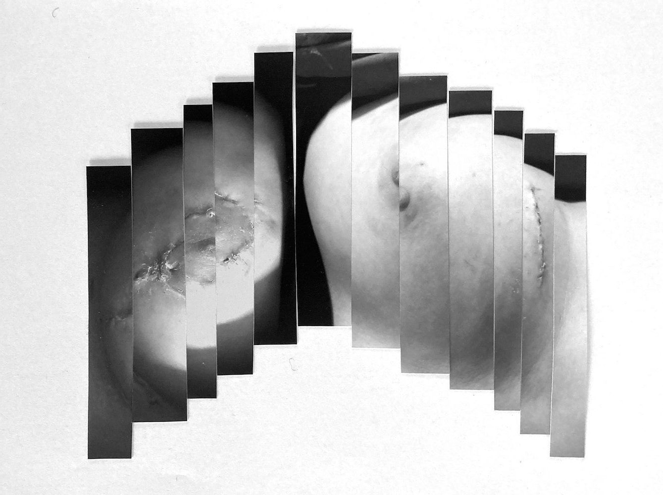 photocollage of healing breasts post reconstructive surgery by Lala Drona