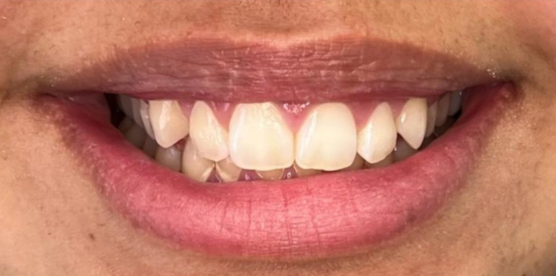 A close up of a person 's mouth with white teeth and pink lips.