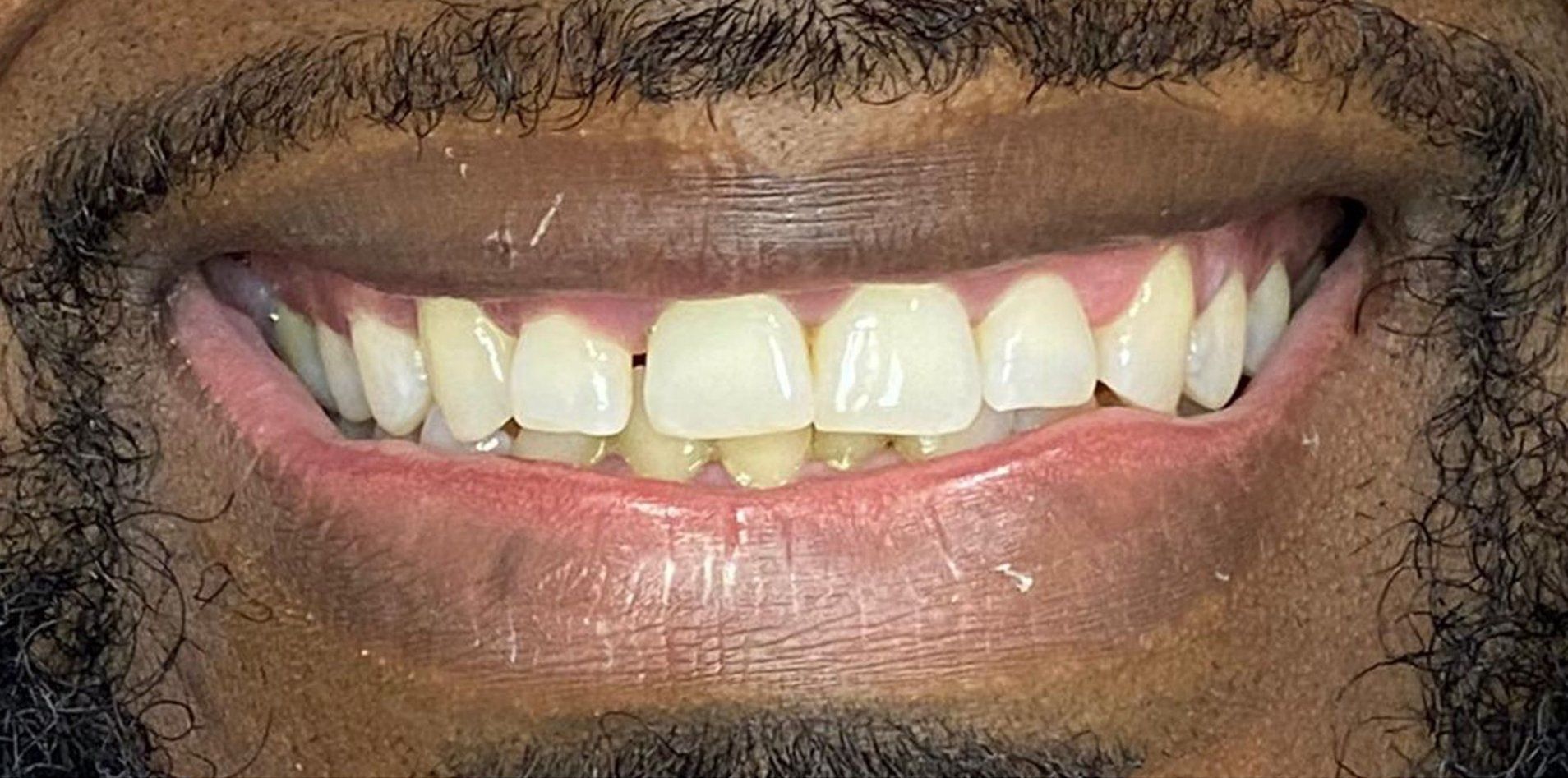 A close up of a man 's teeth with a beard.