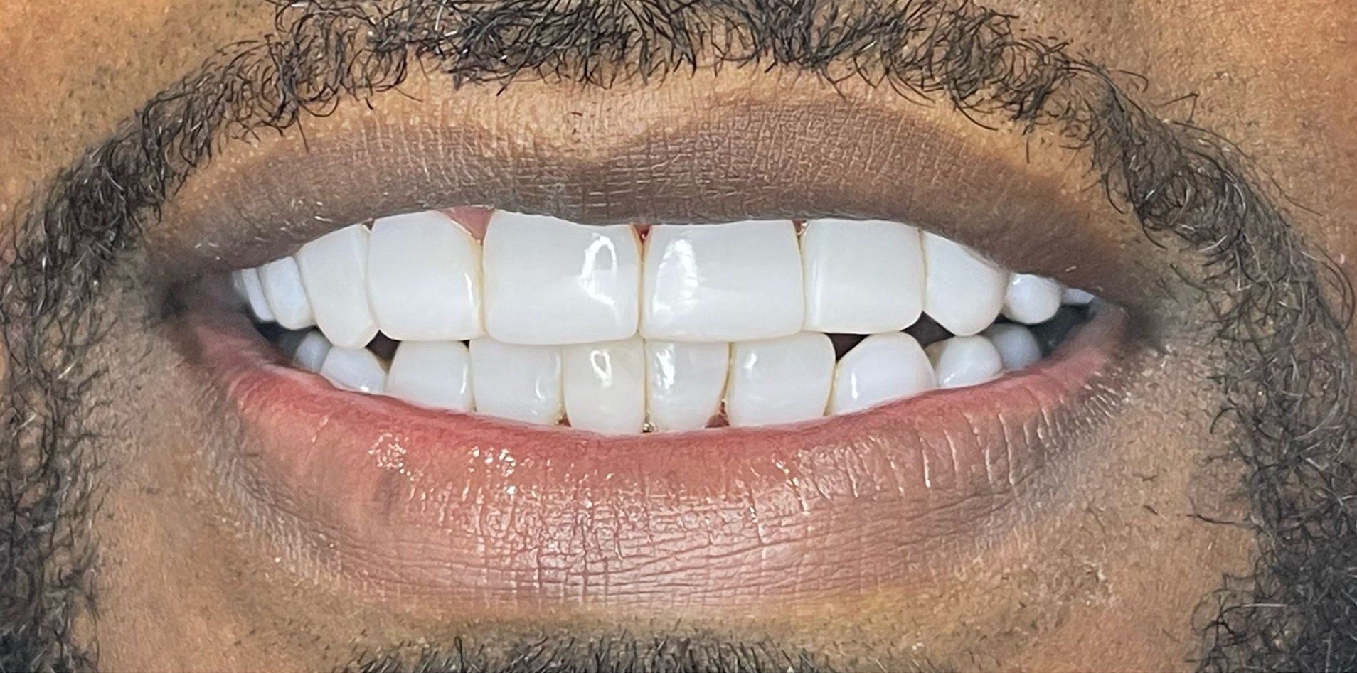 A close up of a man 's mouth with white teeth and a beard.