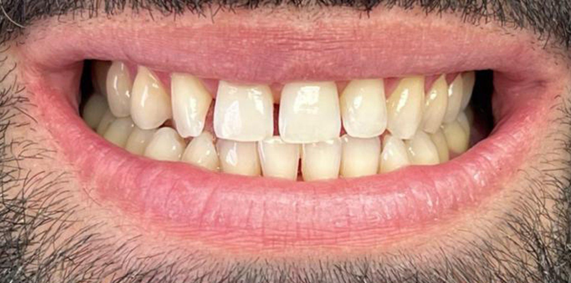 A close up of a man 's mouth with white teeth and a beard.