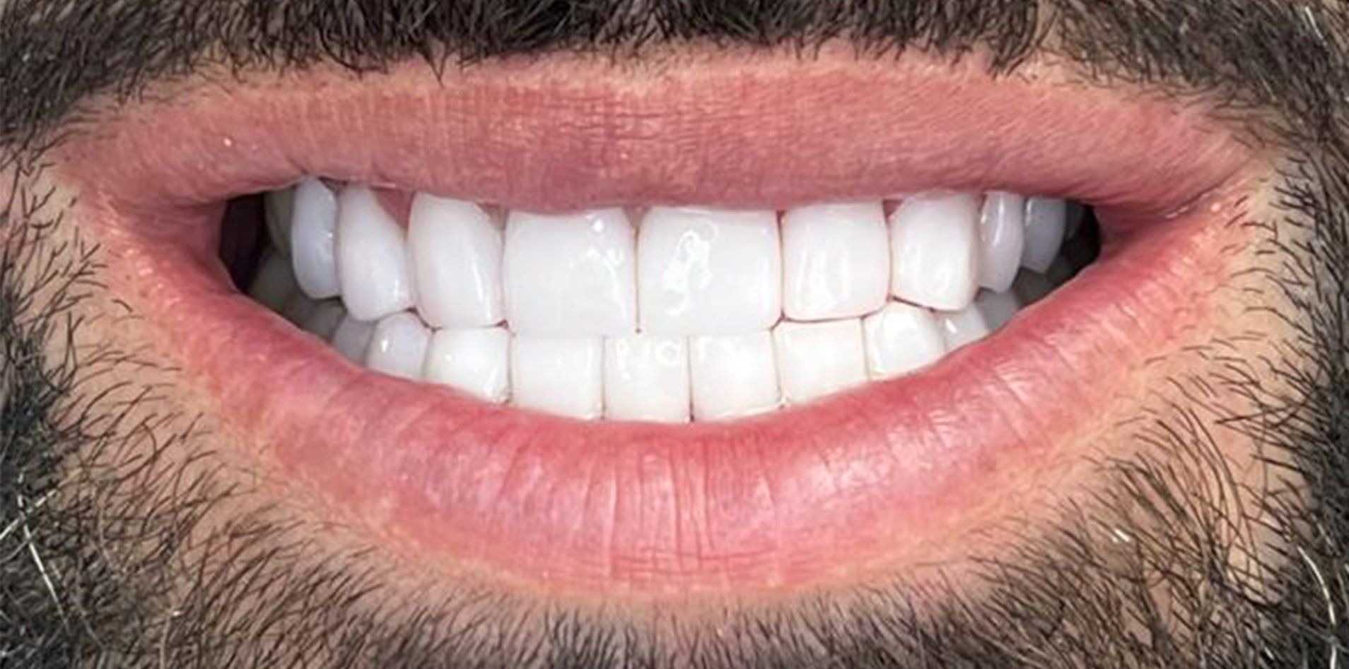 A close up of a man 's mouth with a beard and white teeth.