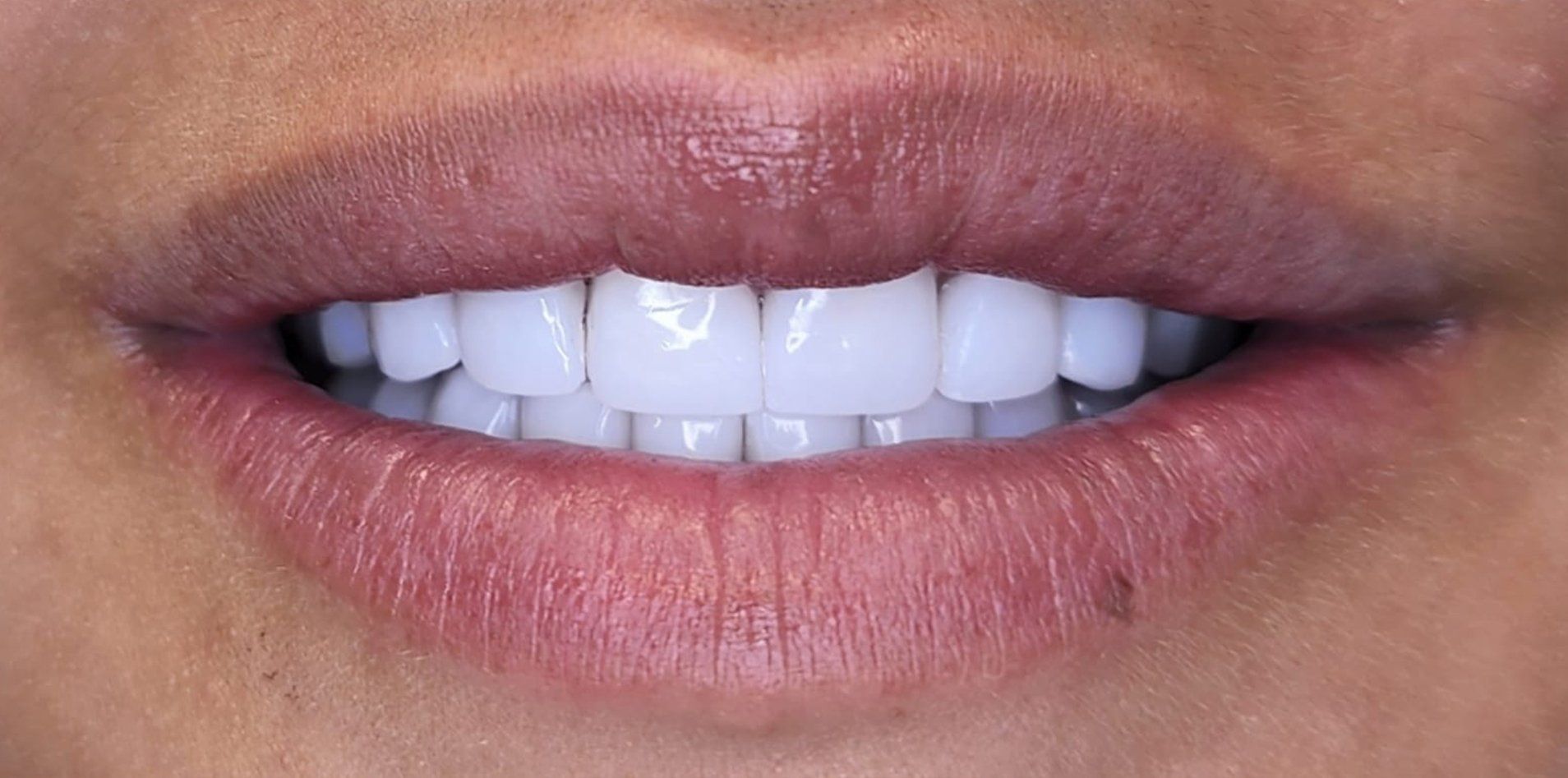 A close up of a woman 's mouth with white teeth.