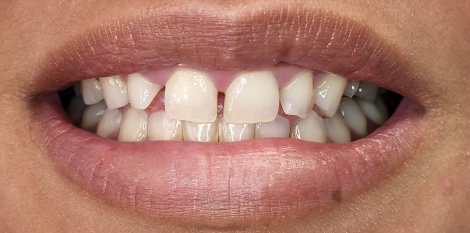 A close up of a person 's mouth showing their teeth.