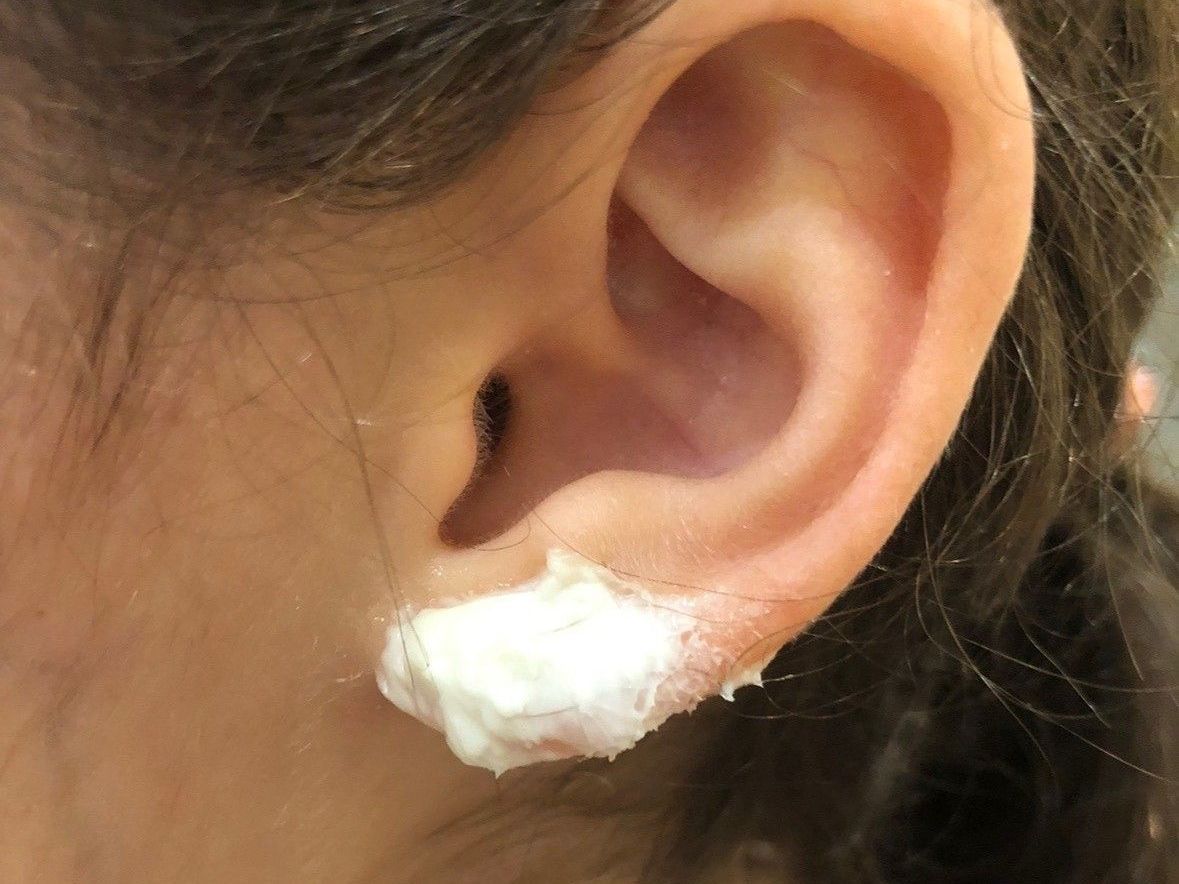 lidocaine cream on child's earlobe