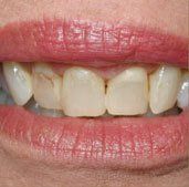 Before Cosmetic Dentistry Anderson, SC