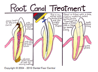 Root Canal Treatment Visual