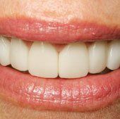 After Cosmetic Dentistry Anderson, SC