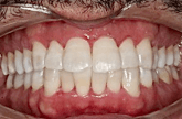 Teeth Whitening in Anderson, SC