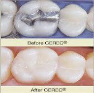 Cermanic Dentistry before and after CEREC