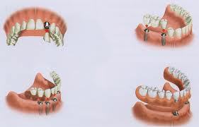 General Dentist Providing Dental Implants in Anderson, SC