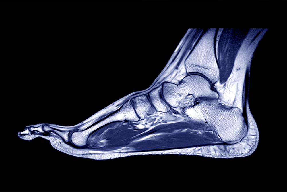 Foot MRI