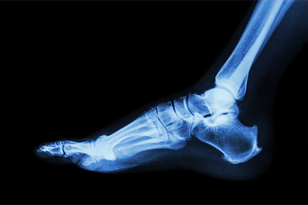 Foot X-Rays