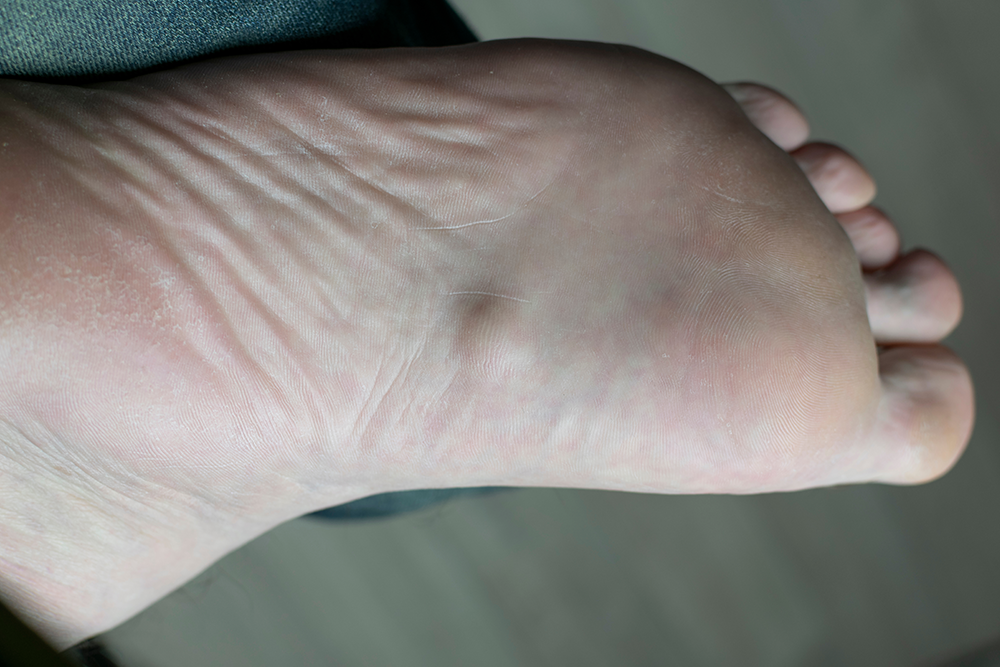 Plantar Fibromas