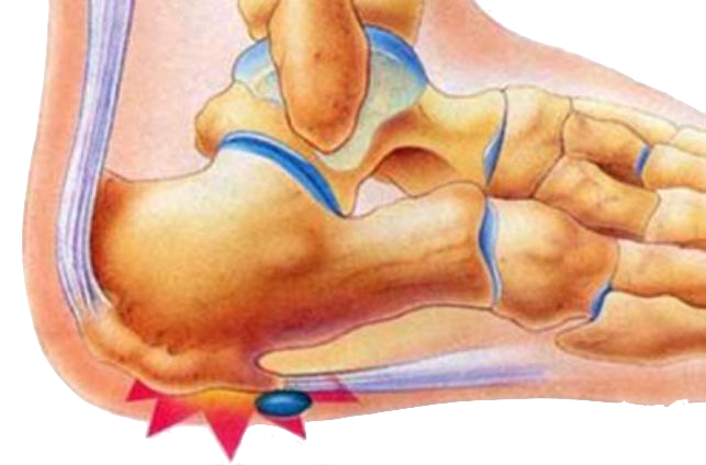 How to Deal with Painful Calcaneal Spur - CuraFoot.in