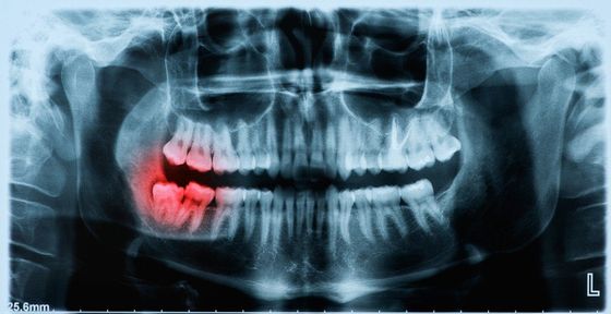 Ortopanoramica dentale con denti infiammati